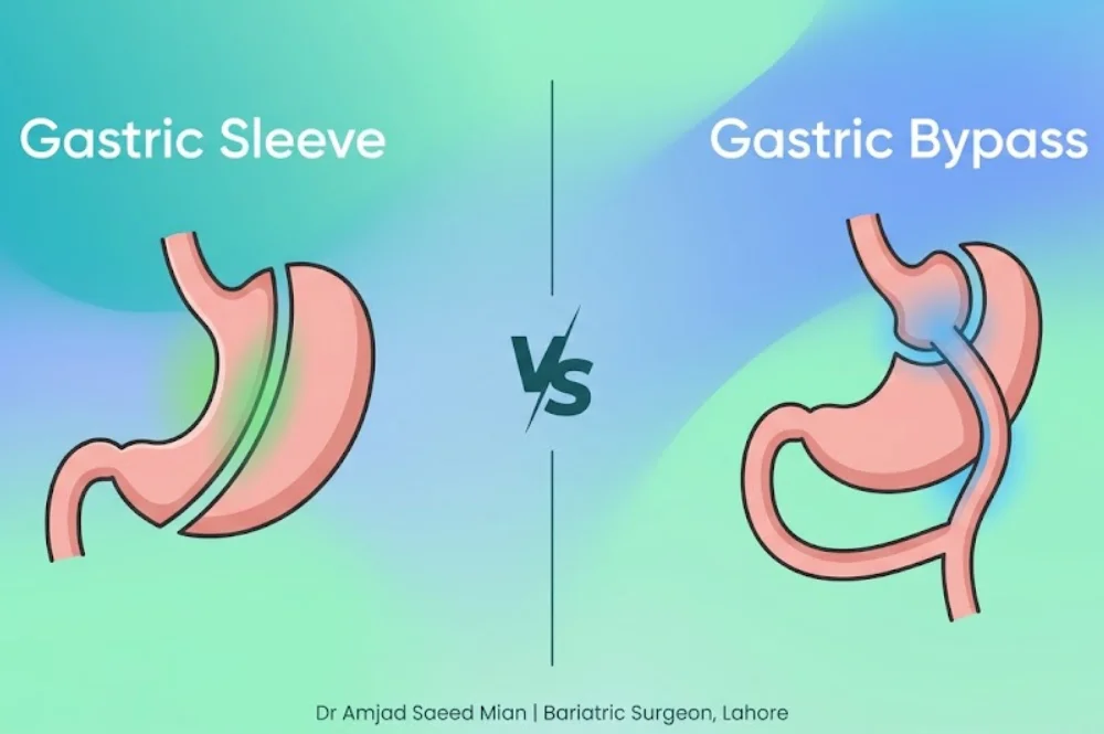 Illustration comparing gastric sleeve and gastric bypass surgery procedures for weight loss in Pakistan